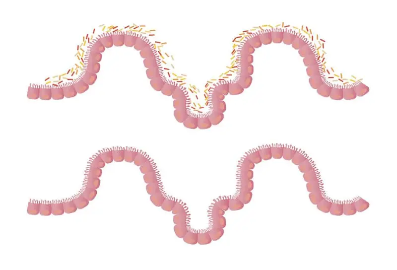 Transplante de Microbiota Fecal (TMF)