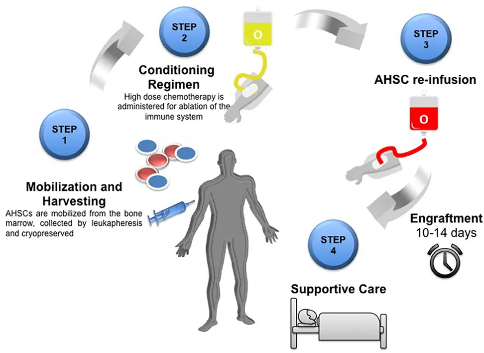 Representación gráfica del trasplante de células madre en un paciente con esclerosis múltiple
