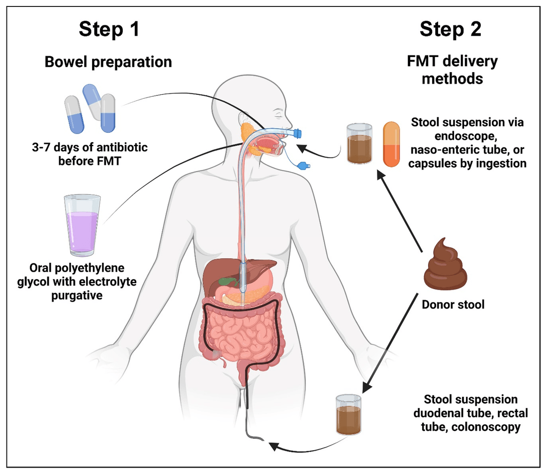 Las dos etapas de un trasplante de microbiota fecal: preparación intestinal y vías de administración del TMF